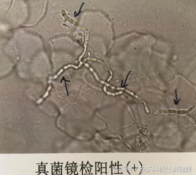 腿上皮肤痒，寻找最佳药膏的全面指南