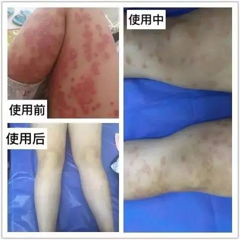 皮肤病100种大全图，认识与理解皮肤健康的全面指南