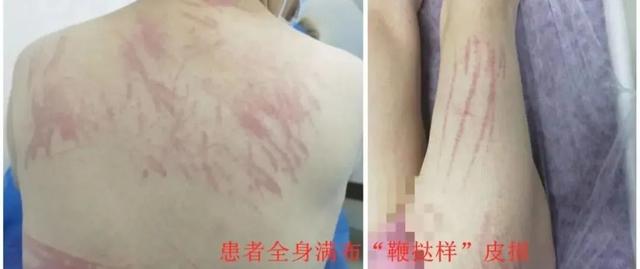 皮肤有红斑瘙痒，了解症状、原因及应对策略