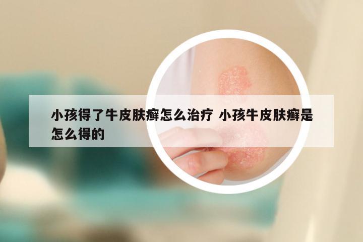 婴儿牛皮肤癣，识别、理解与护理