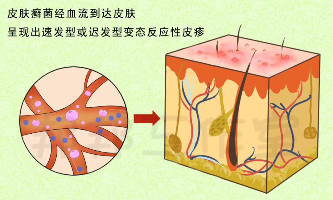 皮肤癣菌病指南，全面了解、预防与治疗