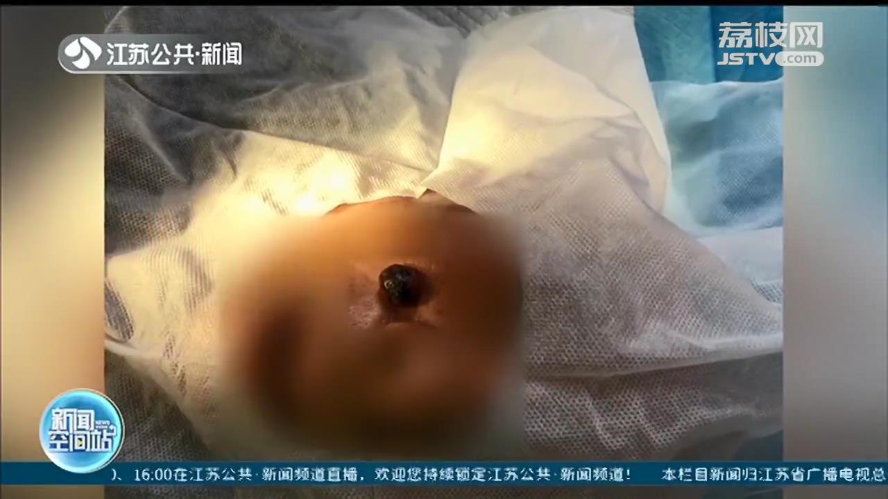 皮肤基底细胞癌，早期症状与图片解析