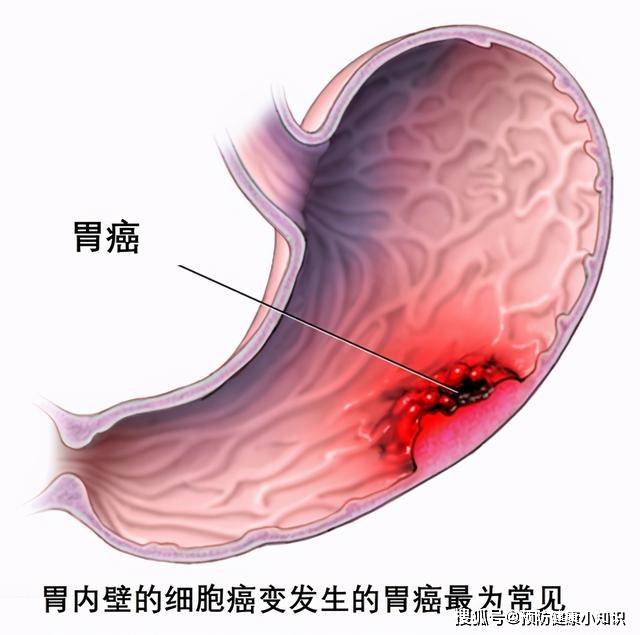 皮肤癌早期症状与感觉，不容忽视的警报信号