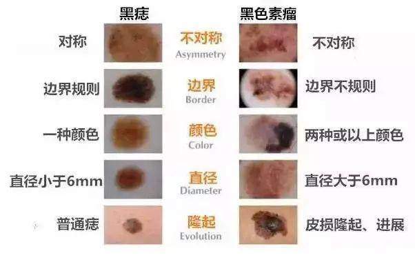 皮肤癌晚期症状图片大全大图