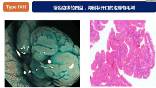 皮肤癌早期，识别、预防与应对策略