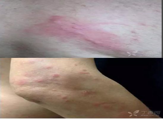 皮炎及其涵盖的皮肤病种类解析