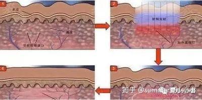 臀部皮肤干燥如鱼鳞，成因、影响与护理策略