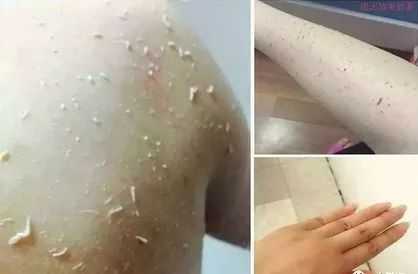 皮肤起白皮屑，原因、影响与应对策略