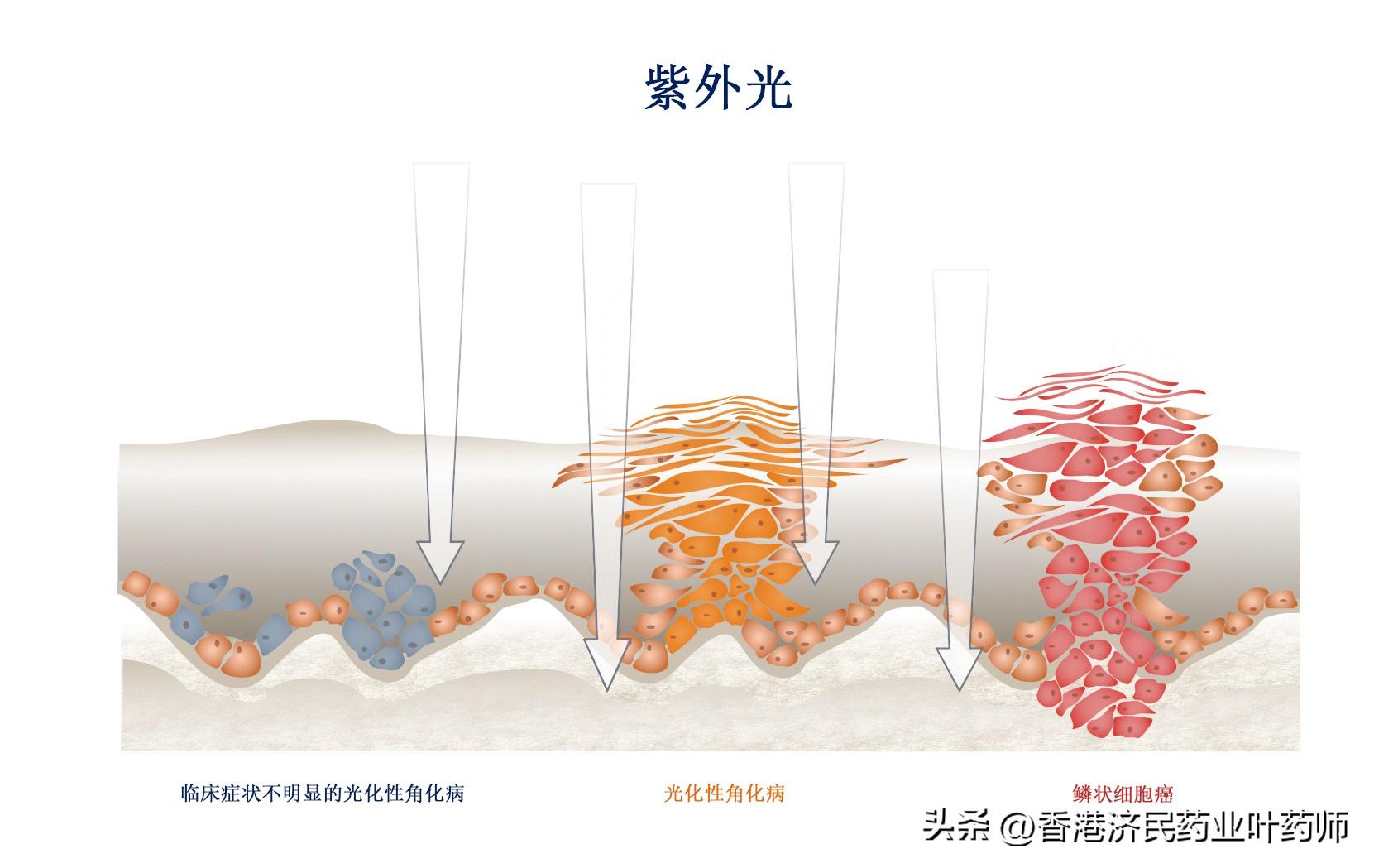 紫外线治疗皮肤病的科学原理与临床应用