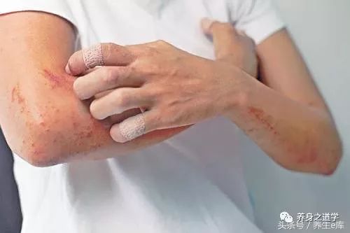 糖尿病皮肤瘙痒的应对策略，药膏选择与护理指南