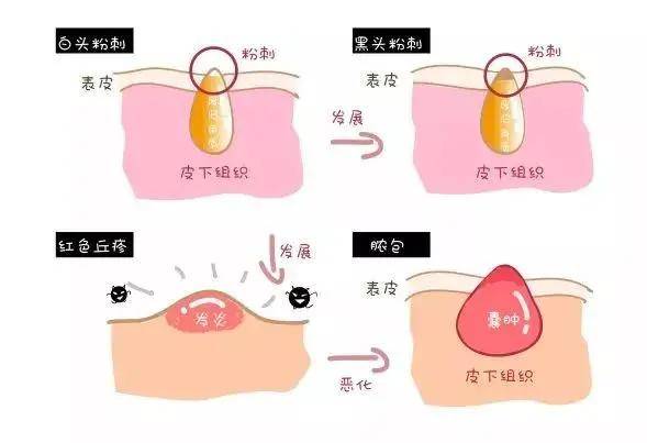 皮肤长闭口，成因、预防与解决策略