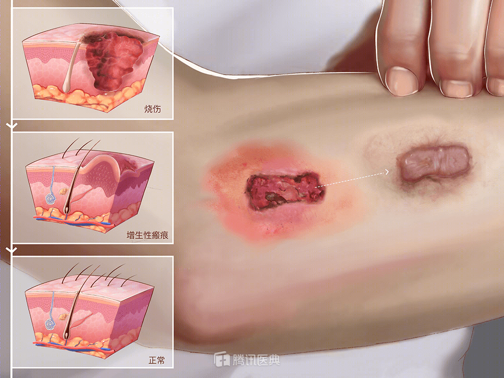 皮肤病理性疤痕，成因、影响与治疗新视角