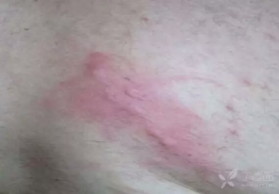 皮肤病种类与大腿部位症状解析，一张图读懂常见问题