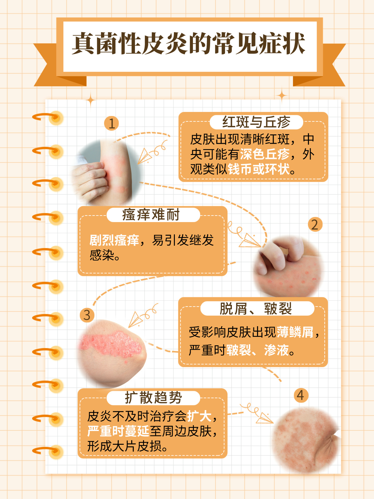 常见的真菌性皮肤病及其防治策略
