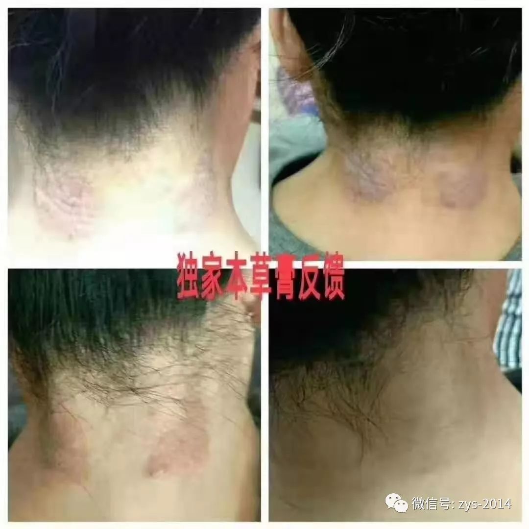 皮肤真菌感染的奥秘，从环境到免疫的复杂交织