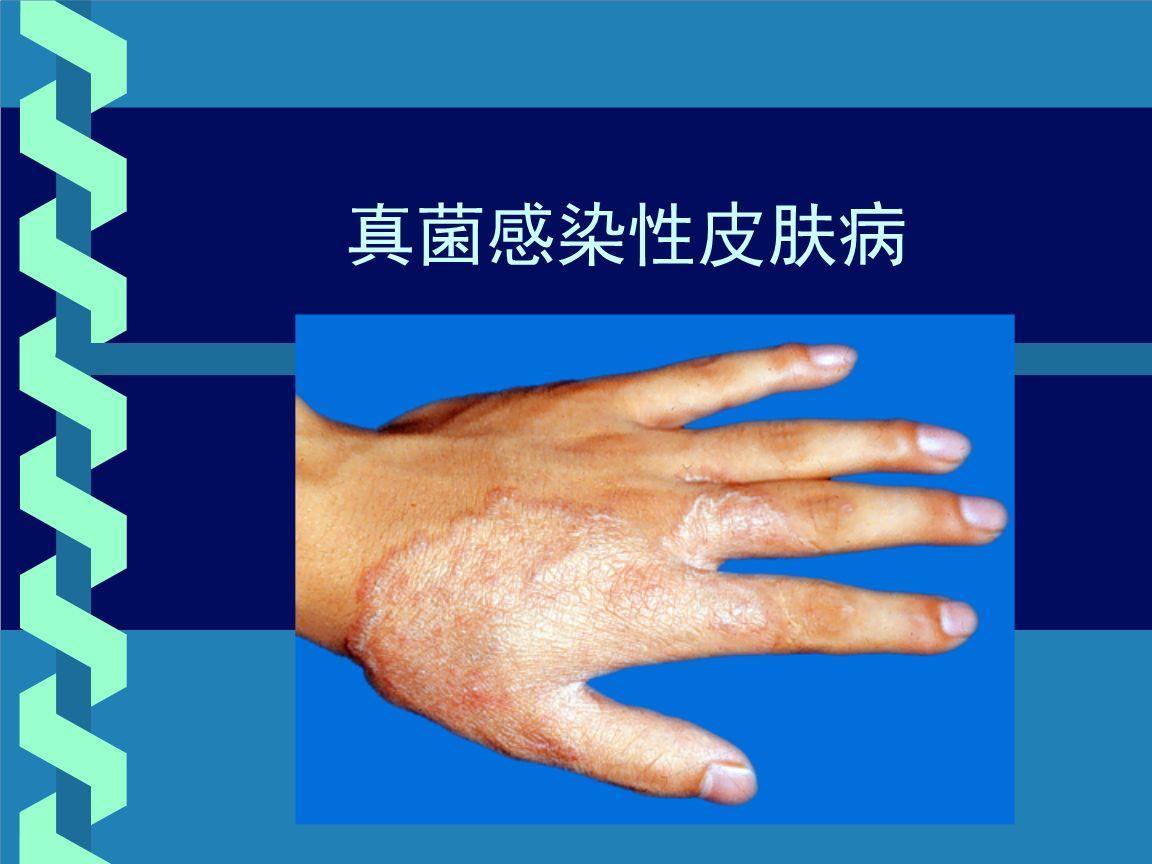 真菌性皮肤病，了解其传染性及预防措施