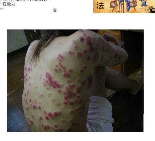 真菌性皮肤病与细菌性皮肤病的区别与防治