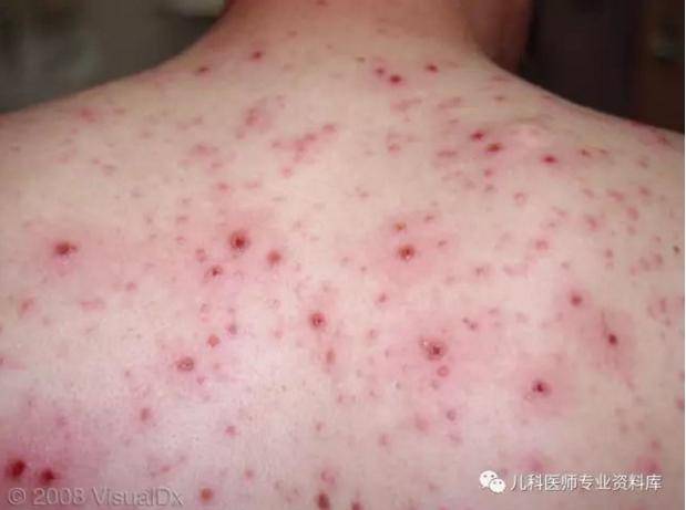 皮肤病图片对照大全，解锁湿疹与疥疮的识别与应对