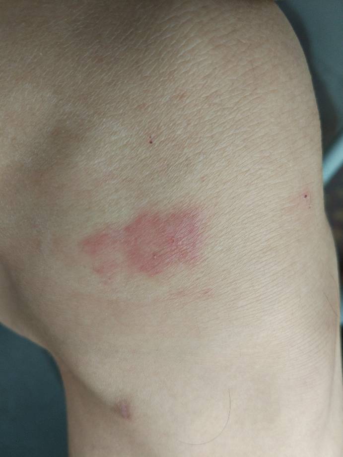 皮肤病中那些让人难以忍受的痒