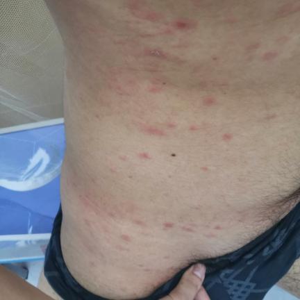 皮肤病中的湿毒类型及其特点解析