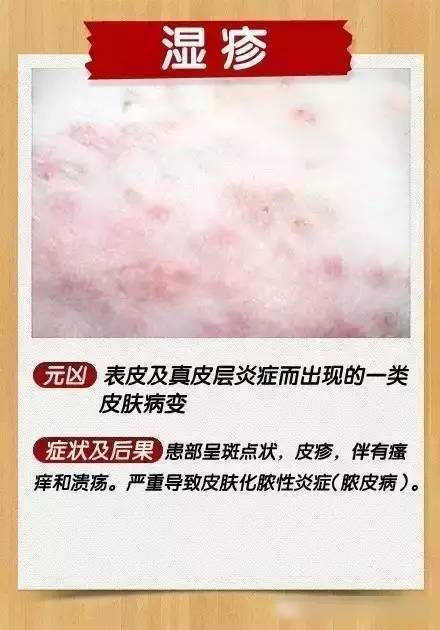 真菌性皮肤病，选择合适药膏的指南