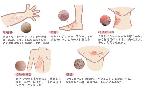 干疙痨皮肤病，治疗与护理的全面指南