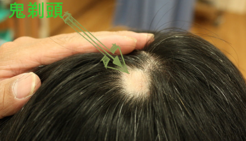 头发突然秃了一块，真相与自我恢复的希望