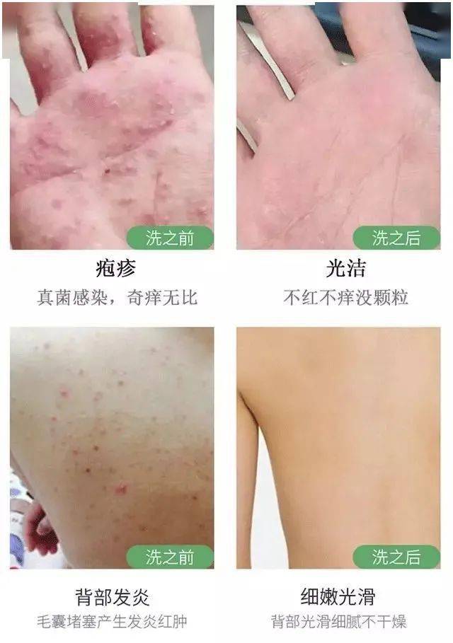 皮肤瘙痒一抓一片红还起疙瘩，探究背后的原因与应对策略