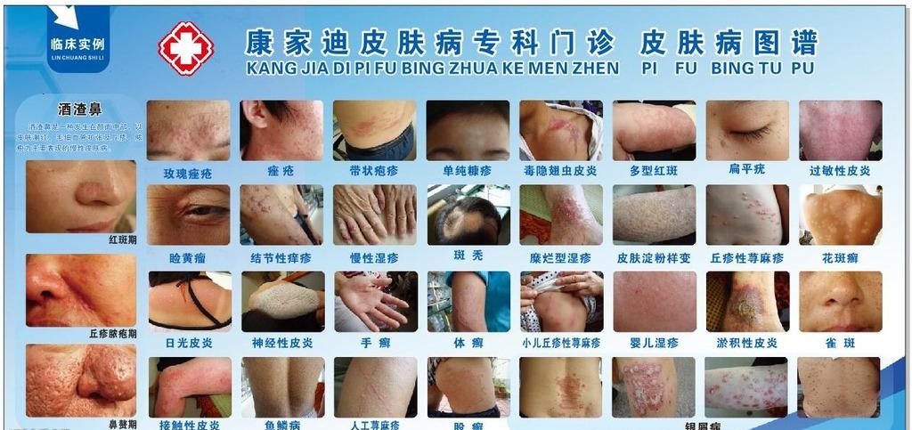 解锁皮肤健康密码，长春肤康医院100种皮肤病对照图片大全指南