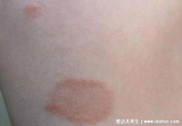 100种常见皮肤病对照图片大全，长春肤康皮肤指南