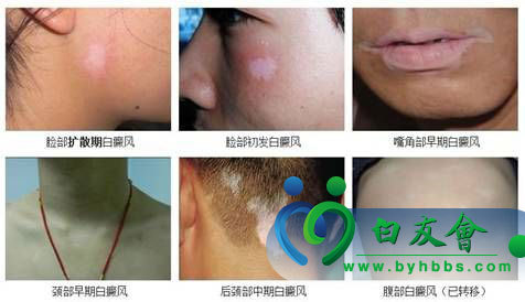 皮肤白点疙瘩，成因、诊断与应对策略