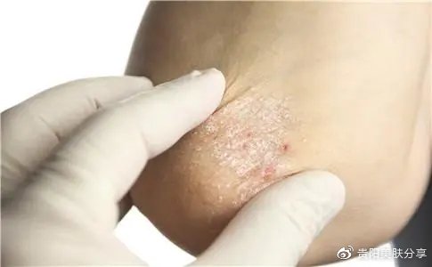 皮肤痒挠完起疙瘩，原因、影响与应对策略
