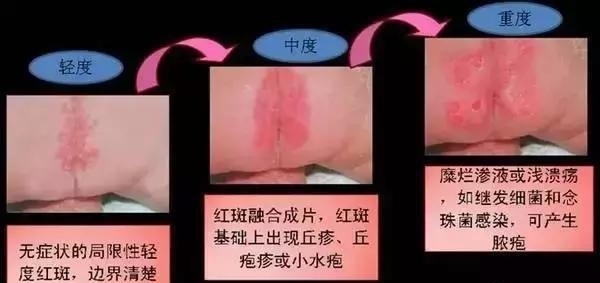 皮肤红色斑疹，如何选择合适的药膏进行治疗