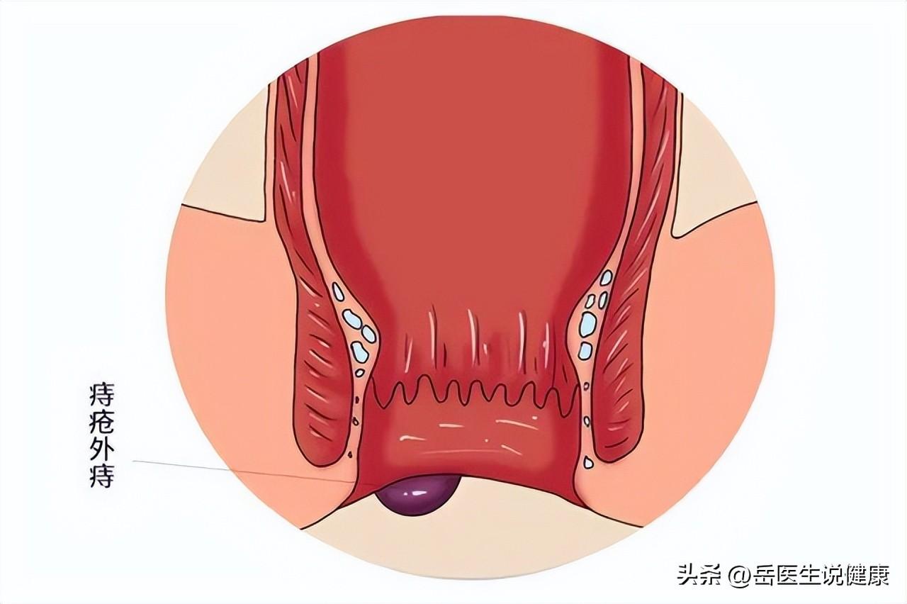 屁股皮肤瘙痒，原因、预防与应对策略