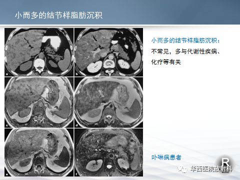 马传贫，肝脏病理变化的深度剖析