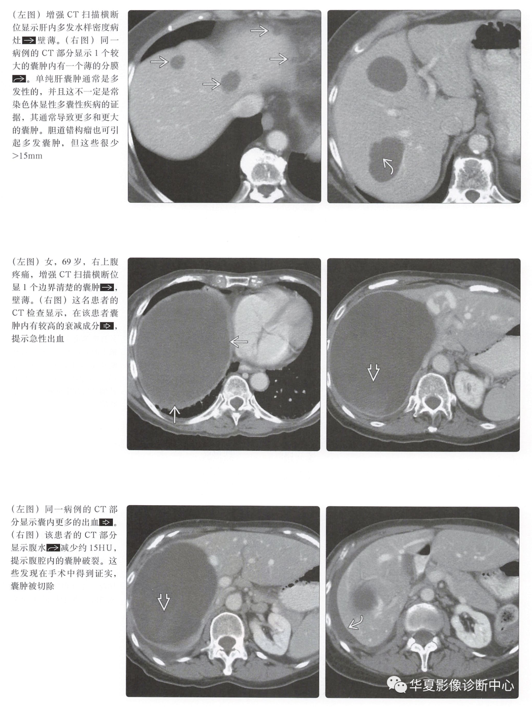 肝脏囊肿的全面解析与治疗策略