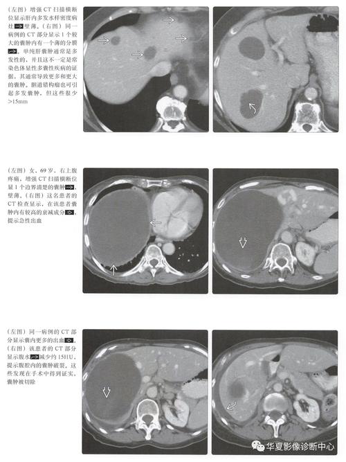 肝脏多发囊肿的全面解析与治疗策略