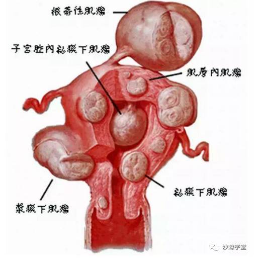 肝脏囊肿的最佳治疗效果，综合策略与最新进展