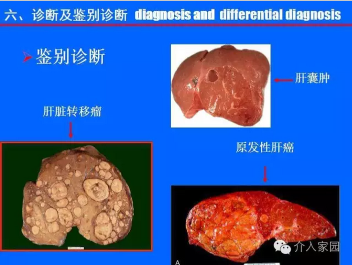 肝脏血管瘤3公分，危险性评估与治疗必要性探讨