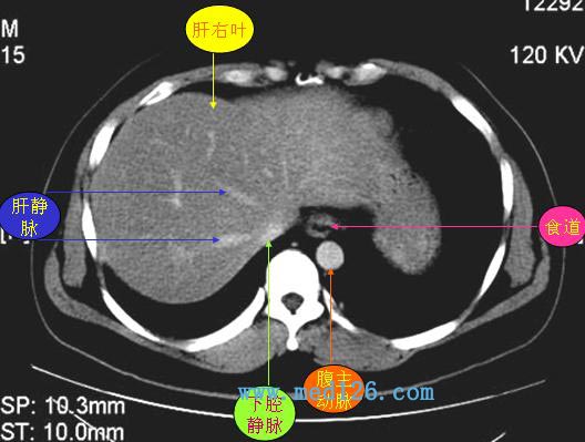 肝脏CT的解读，从基础到进阶的图解指南