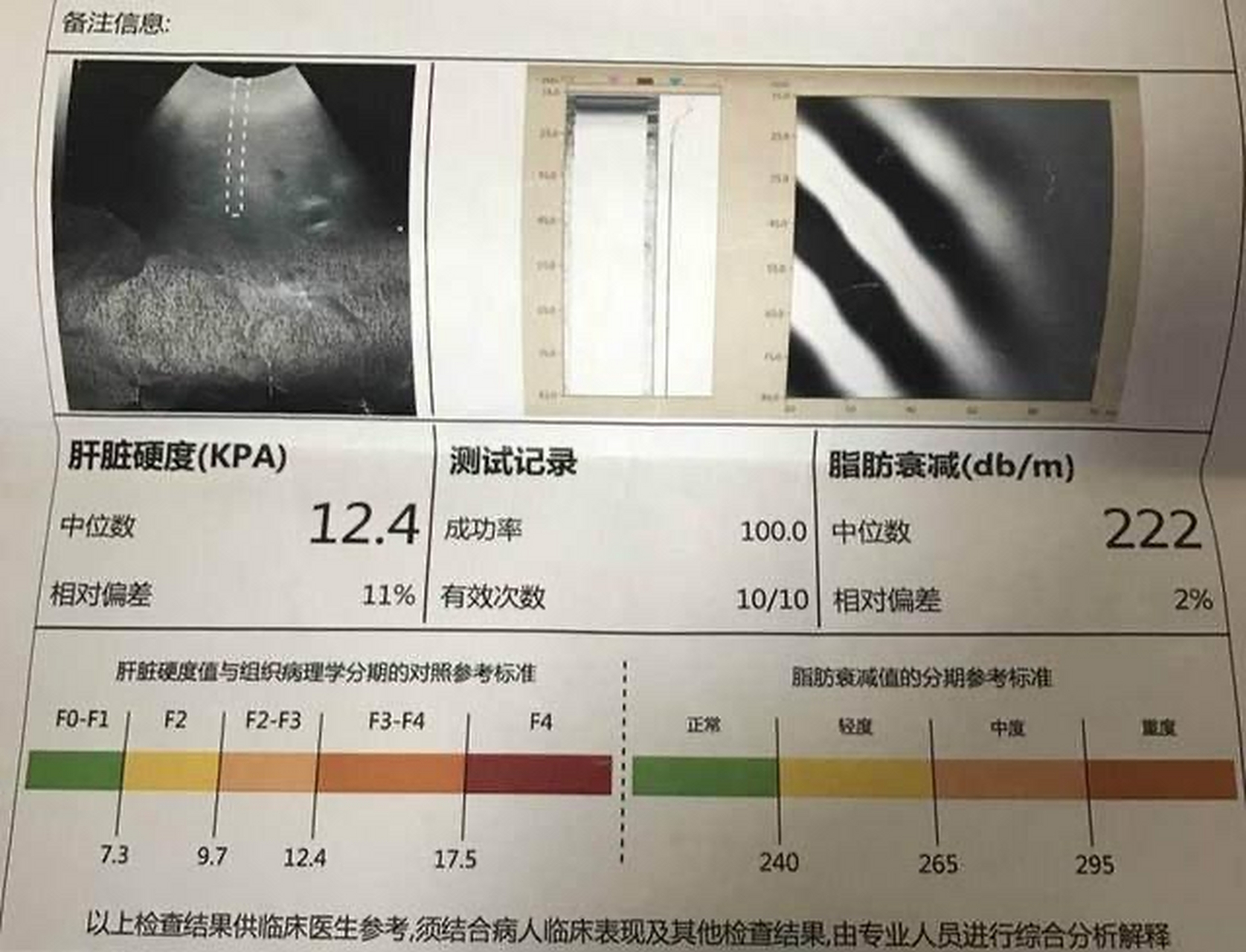 肝脏硬度kPa正常值与轻度脂肪肝的肝硬度解析