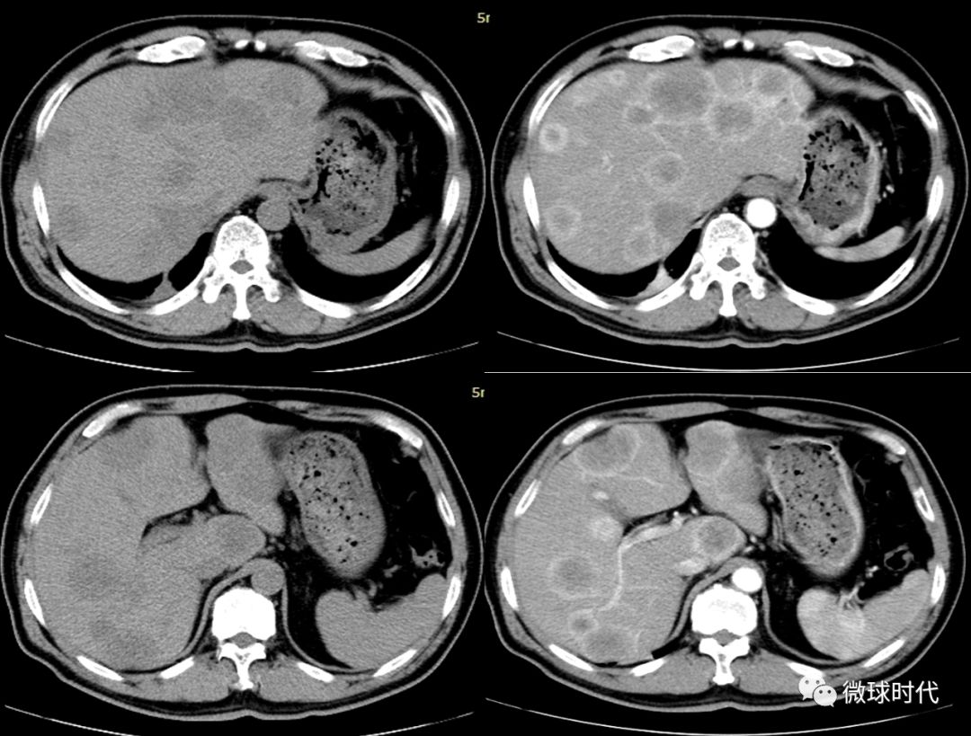 肝脏多发低密度灶，解读与严重性探讨