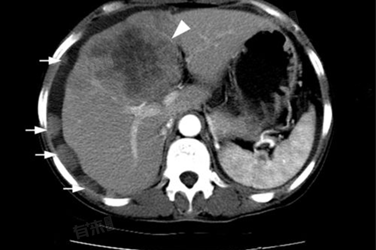 肝脏多发低密度灶，解读与治疗必要性