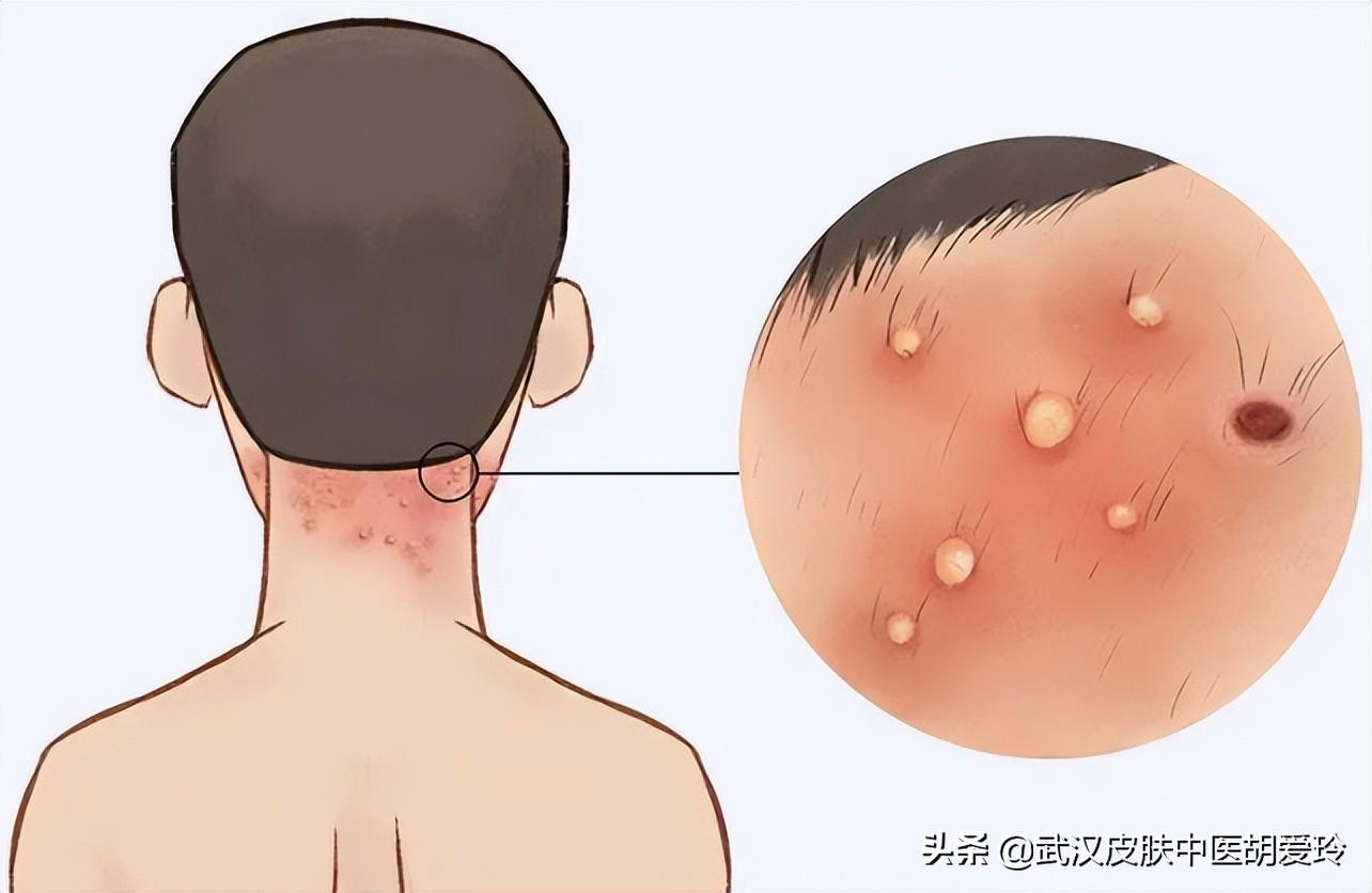 脖子皮肤痒，不可忽视的细微信号
