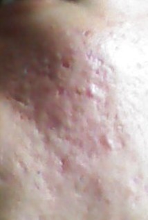 皮肤刺痒，表面无现象的神秘之谜