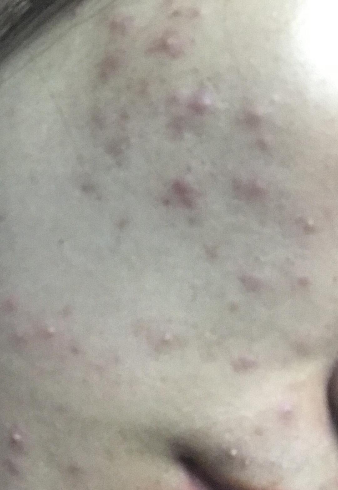 换季皮肤痒，小红疙瘩的背后故事