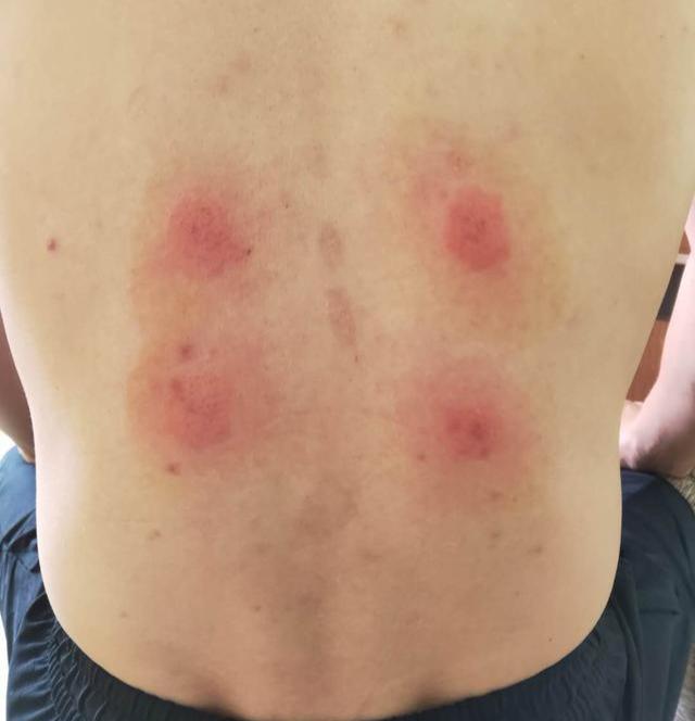 皮肤痒一抓就起一片红疙瘩，探究背后的原因与应对策略