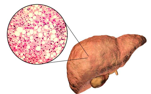 警惕肝脏健康警报，识别肝脏出现问题的征兆