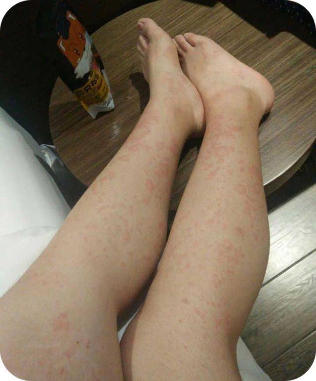 皮肤上的痒痒症，小疙瘩越挠越痒的背后真相