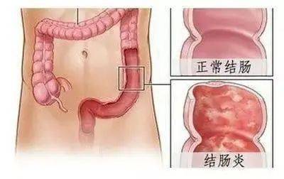 肠胃炎的疼痛地图，全面解析症状分布与感受